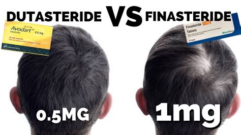 dutasteride vs finasteride hair loss